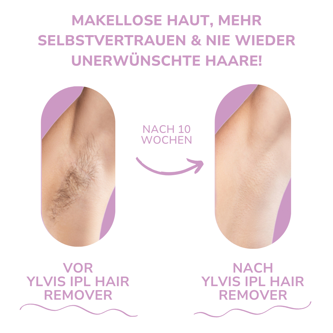 SilkEase | IPL Hair Remover